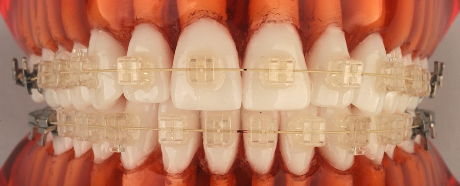 aparatologia-fija-evolucion-tecnica-cervera-cursos-ortodoncia