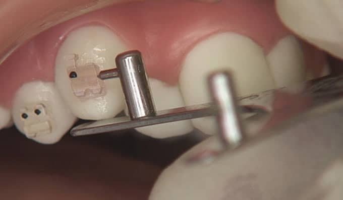 Cementado de maloclusiones completas con brackets convencionales y estéticos Cementado de maloclusiones completas con brackets convencionales y estéticos