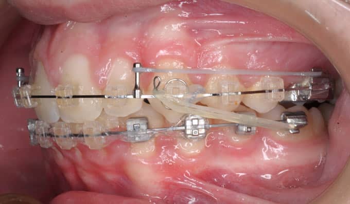 Distaladores, expansores y estabilizadores del maxilar. Desarrollo mandibular Distaladores, expansores y estabilizadores del maxilar. Desarrollo mandibular