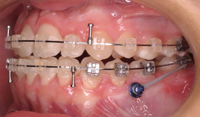 Trastornos obstructivos del sueño y aparatos de avance mandibular Trastornos obstructivos del sueño y aparatos de avance mandibular