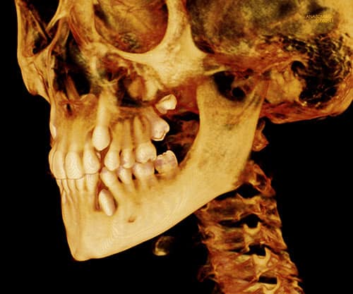 Agenesias de laterales, premolares y otros dientes. Agenesias de laterales, premolares y otros dientes.